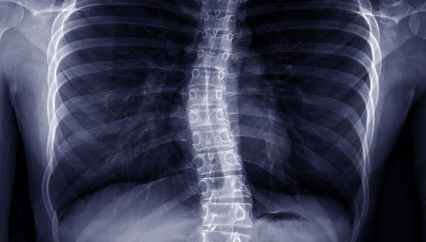 patient needing scoliosis  treatment in Irvine