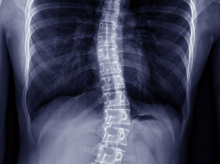 scoliosis treatment in Irvine